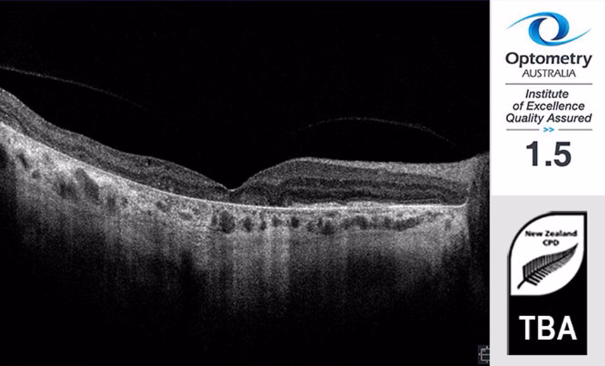 Imaging of geographic atrophy.