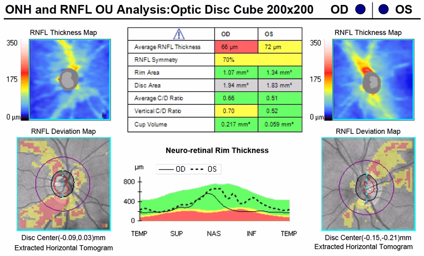 An ocular coherence tomography (OCT) scan of the neuro-retinal rim of the right eye, showing neuro-retinal rim thinning.