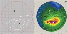 Topography-based pattern of CXL utilised in piXL