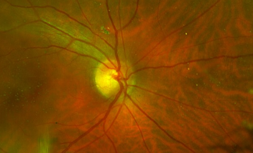 Fundus biomicroscopy image for case 1 (NM) to measure CDR (cup-to-disc ratio)