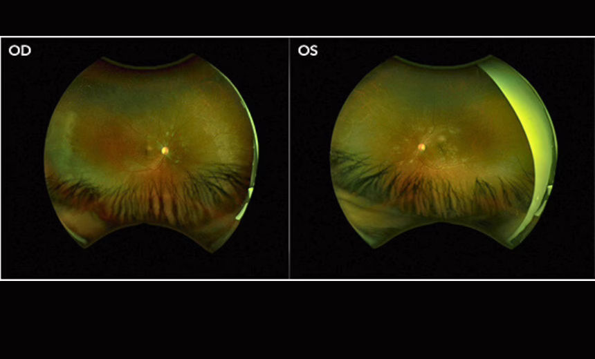 An OCT image of a patient with bilateral NPDR before laser treatment.