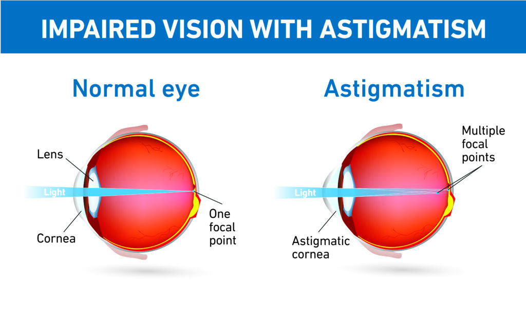 Can Laser Eye Surgery Fix Astigmatism