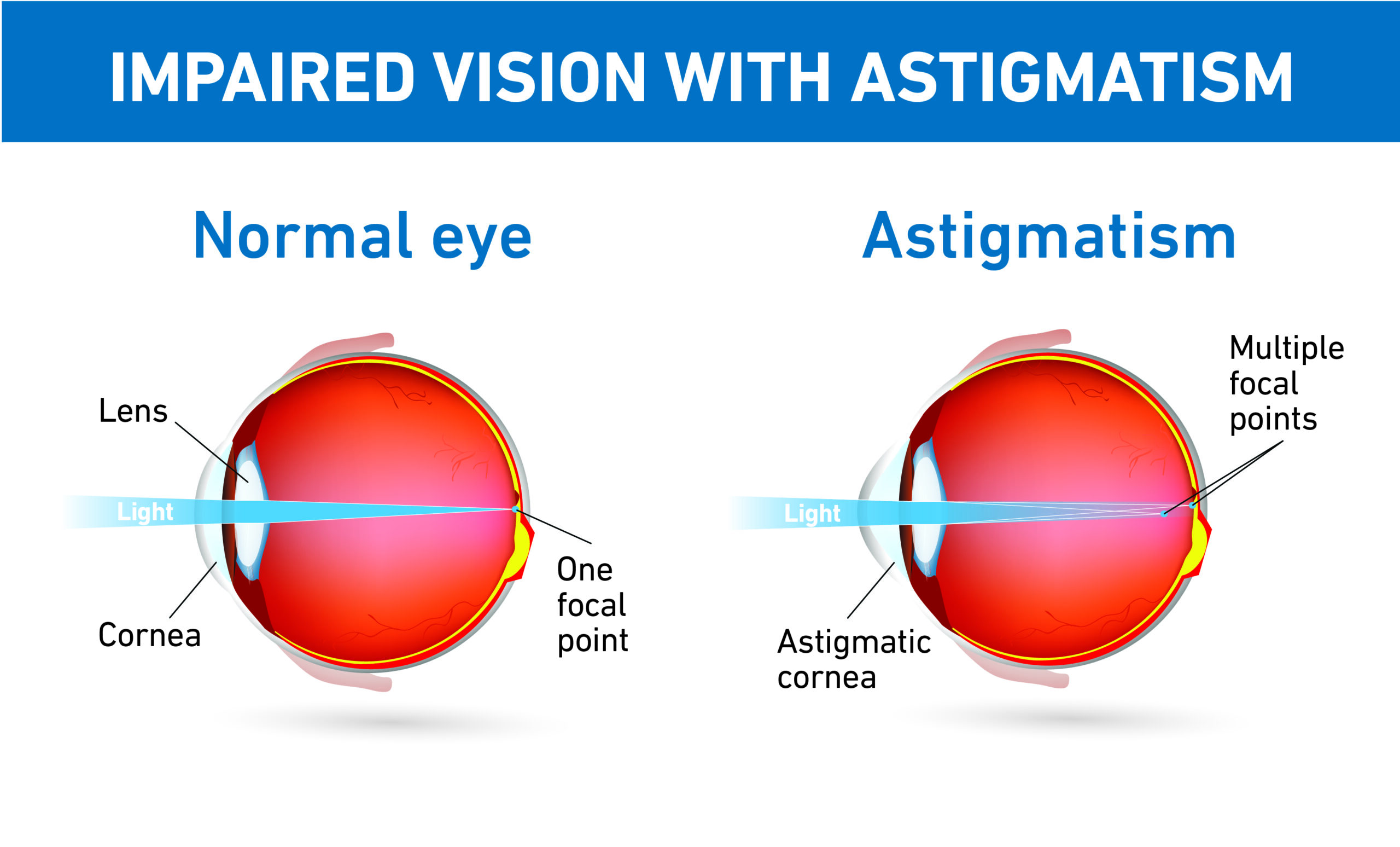 Napravuje LASIK astigmatismus?