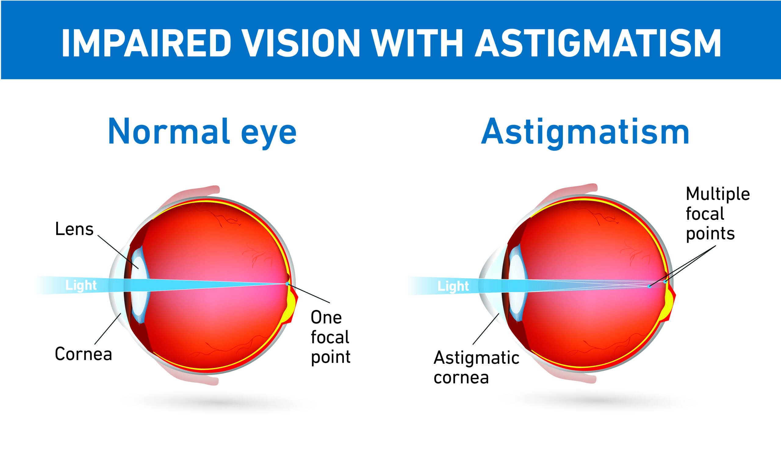 Corrective store eye surgery