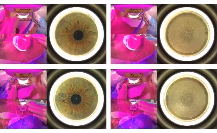 4 quadrant camera progression images of iris and operation