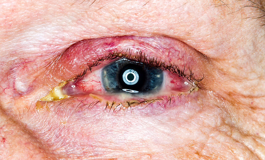 Close up of eye with bacterial conjunctivitis