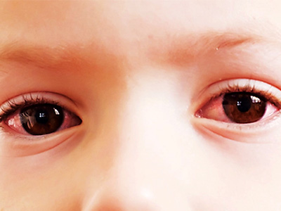 Child with conjunctivitis in both eyes
