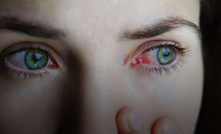 conjunctivitis or pink eye sufferer