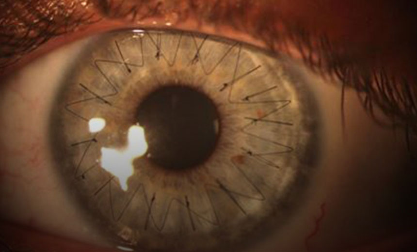 Close-up image of the eye after corneal transplantation