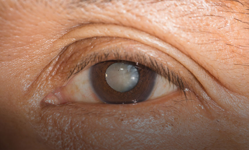 Does your eye colour influence cataracts?