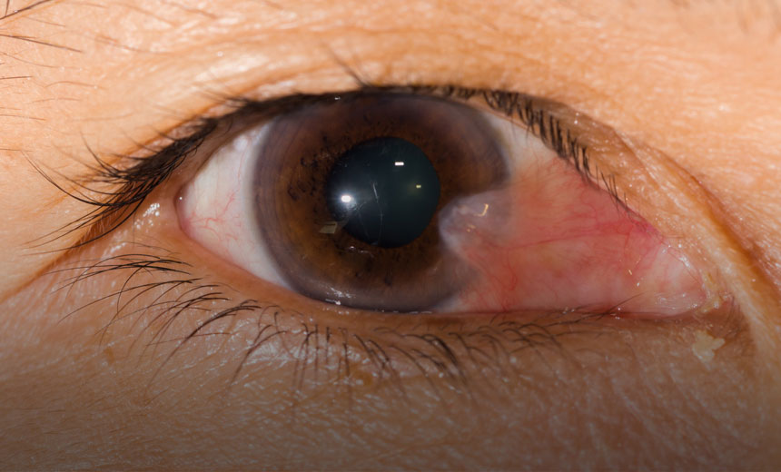 Close up of an eye with a pterygium (Surfer's eye)