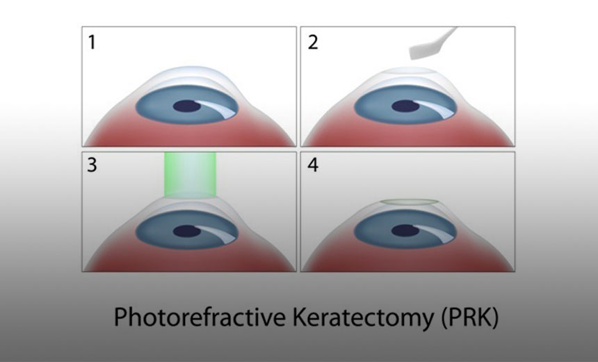 What is PRK (Photorefractive Keratectomy)?