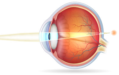 diagram of an eye with hyperopia