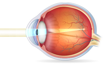 diagram of an eye with myopia