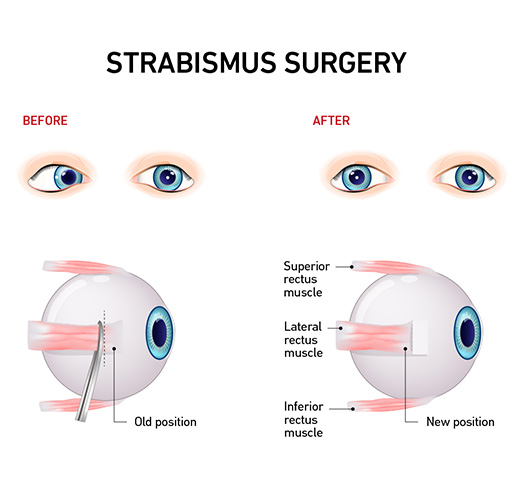Strabismus surgery – before and after diagram