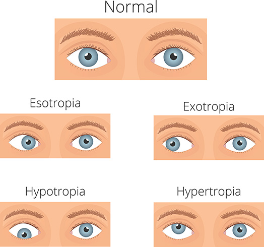 Five types of crossed eyes diagram