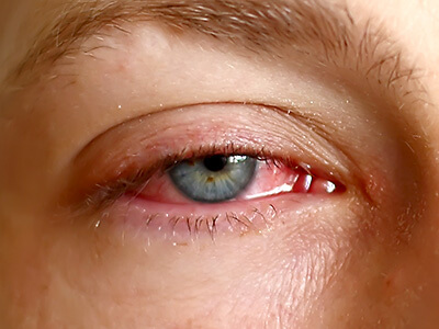 Viral conjunctivitis